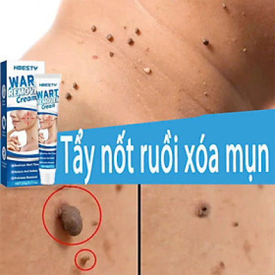 Kem Mụn Cóc, Mụn Thịt, Mụn Cơm Hiệu Quả – Chiết Xuất Thảo Dược An Toàn 20g, ĐÈN TRANG TRÍ , ĐỒNG HỒ TREO TƯỜNG
