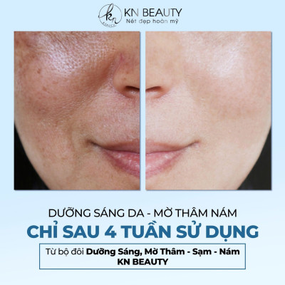 Combo 2 sản phẩm Trắng Da Ngừa Nám KN Beauty chuyên sâu: Kem dưỡng 10g + Serum 30ml