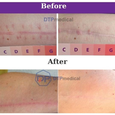 Gel Silicone Bapscarcare trị sẹo lồi, sẹo phì đại, sẹo mổ sau khi phẫu thuật, Gel Bapscarcare làm phẳng, làm mềm và mờ sẹo lâu năm hiệu quả (Tuýp 7g)