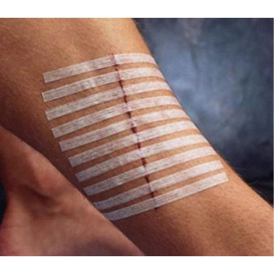Miếng dán thay chỉ khâu da Steri-Strip R1541 6mm x 75mm (1/4IN x 3IN)