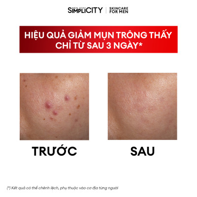 Serum Men Stay Simplicity cho da mụn giúp làm dịu, khô cồi cho nam Calm Skin Relief Facial Serum 30ml