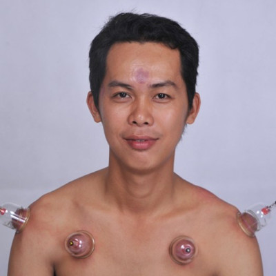 Bộ Giác Hơi Không Dùng Lửa Duy Thành YGH01